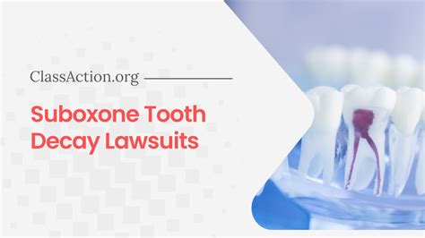 That will involve a class action lawsuit against Suboxone. . Class action lawsuit suboxone tooth decay
